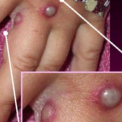Monkeypox a darh leh