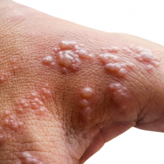 Monkeypox Chungchang